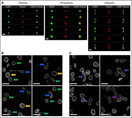 Imaging of platelets, preplatelets, and barbells in normal human blood. (A) Healthy control trisodium citrate blood was labeled immediately after phlebotomy with FITC anti-CD61 and AF674 SiR tubulin (4 μM) for 30 minutes at 37°C, and 10 000 CD61+ platelet images were acquired with ISFC. SiR tubulin labeling clearly depicts the marginal band of platelets, preplatelets (ii), and barbell platelets (iii), discriminated by ISFC (×60 magnification). Images are representative of a single experiment (n = 5). Bars represent 7 μm. (B) Platelet-rich plasma were separated from citrated whole blood immediately after phlebotomy at 37°C and were labeled for α-tubulin and imaged using super-resolution structured illumination microscopy. Original magnification, ×100; n = 3. Circular platelets (≤3 μm; green arrows) and preplatelets (≥3 μm; yellow arrows) are shown along with barbell platelets (blue arrows). (C) Circular platelets are shown along with intermediate elongated preplatelets (purple arrows). Bars represent 5 μm.