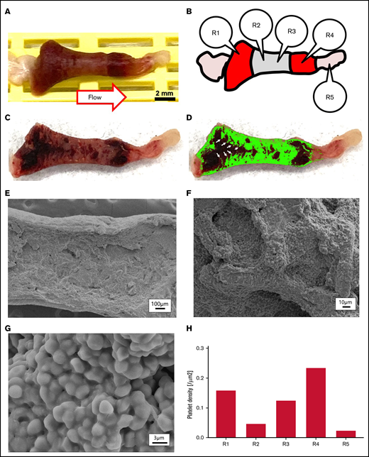Harvested SIPA clot and SEM images. (A) A SIPA clot retrieved from the large glass tube was formalin fixed and dehydrated with ethanol. (B) Schematic of a SIPA clot with regions of interest (R1-R5). (C) A SIPA clot cut in half to expose the cross section. (D) The platelet-rich white region is highlighted in green, showing fingers of platelet aggregates (white arrows). (E-G) SEM image of SIPA clot region of interest R4. (E) Low magnification SEM image of the SIPA clot showing the dense core of the thrombus. (F) Moderate magnification SEM image of the SIPA clot illustrating a textural surface of platelet aggregates. (G) High-magnification SEM image of the SIPA clot showing amorphous platelets that are likely activated with degranulation. (H) Platelet density from SEM images of regions R1 to R5.