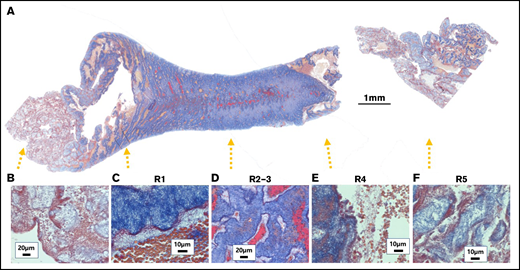 Carstairs staining of a SIPA clot in the longitudinal direction. (A) The trumpet-like morphology of the gross clot was preserved. (B-F) Each end of the clot showed small platelet aggregates with fibrin. (C) Upstream of the throat, the thrombus had platelet aggregates protruding toward the lumen with string or fingerlike shapes alternating with trapped RBCs. Some strings were 10 times longer than they were wide. (D) The apex of stenosis was fully occluded with platelets. Some fibrin was found in the center of the lumen and pores. (E) Downstream, the clot was present at the center and near the wall; whereas the annulus between the 2 had sparce RBCs and fibrin without platelet aggregates. R1 to R5 correspond with the regions of interest shown in the schematic in Figure 2B.