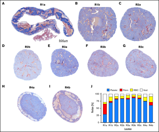 Carstairs staining of the SIPA clot in the transverse direction. (A-I) Starting from the upstream end, each section is spaced ∼0.5 mm apart. (J) The plot shows portion of blood clot components (platelet, fibrin, RBC, and void) found in Figure 4 A to I. Sequential sections corresponding to the regions of interest indicated in Figure 2B (R1a-R4b).