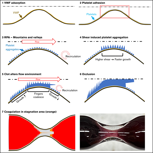 Process of SIPA clot formation in a large stenotic vessel. (1) Schematic showing the bottom half of a stenosed vessel. The dotted line indicates the axisymmetric centerline. VWF (brown) adsorption onto the collagen surface under high shear rate. (2) Sparce platelet adhesion (light blue) to the surface. (3) Details of the dotted box in panel 2. RPA begins and forms mountains and valleys of platelet aggregates. (4) SIPA accelerates the thrombus growth with higher shear rate near the apex. (5) Growing thrombus at the apex alters the flow environment and creates larger recirculation region downstream. (6) SIPA clot occludes the vessel. (7) Final SIPA clot (light gray) comparison between the schematic (left) and the experimental photograph (right).