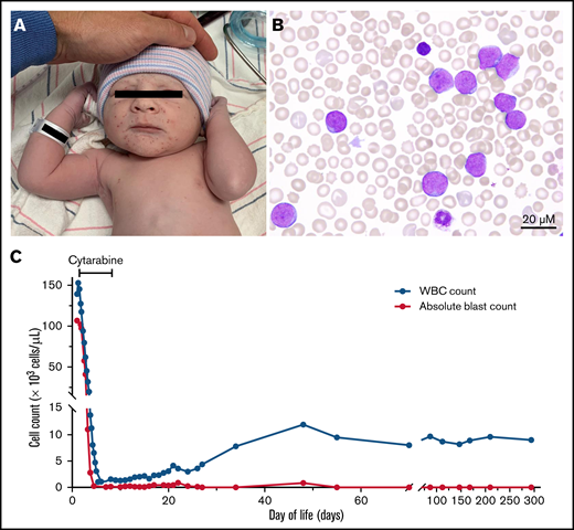 Patient presentation and acute leukemia evaluation. (A) Petechial rash on face, scalp, and torso was present at birth and prompted evaluation with a complete blood count. (B) Peripheral blood smear shows presence of myeloblasts. (C) Graph shows white blood cell and absolute blast count over time, highlighting response to cytarabine therapy.