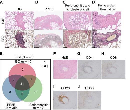 Bronchiolitis, perivascular inflammation, and peribronchitis characterize human pulmonary GVHD. (A-D) Representative images of human pulmonary GVHD. Upper images are H&E stained, and lower figures are EVG stained. (A) BO, (B) PPFE, (C) peribronchitis and cholesterol cleft, and (D) perivascular inflammation. (E) Numbers of patients who had BO, PPFE, peribronchitis, and organizing pneumonia (OP), with overlap among the patients shown. (F-J) Images of specimens stained with H&E (F) or immunohistochemically stained for CD4 (G), CD8 (H), CD20 (I), and CD68 (J) in bronchiolitis.