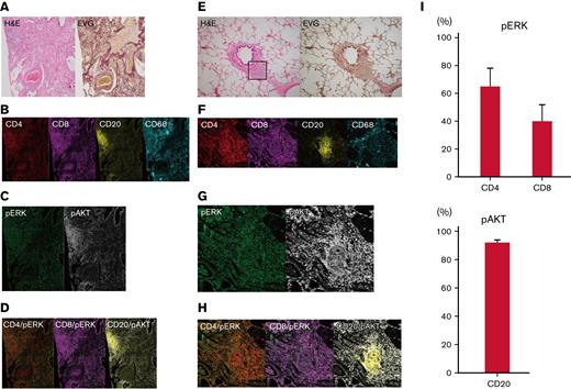 T cells around bronchioles in human pulmonary GVHD are positive for pERK and B cells are positive for phosphorylated AKT (pAKT). Representative images of tissue samples from human patients with pulmonary GVHD. (A) Images of specimens from patient #1 stained with H&E or EVG. BO (upper right) and perivenulitis (lower left) were present. (B-D) Images of samples from patient #1 captured by imaging mass cytometry: (B) CD4, CD8, CD20, and CD68; (C) pERK and pAKT; (D) merged images of CD4/pERK, CD8/pERK, and CD20/pAKT. (E) Images of specimens from patient #2 stained with H&E or EVG. The area enclosed by the square was analyzed by imaging mass cytometry. (F-H) Images from patient #2 captured by imaging mass cytometry: (F) CD4, CD8, CD20, and CD68; (G) pERK and pAKT; (H) merged images of CD4/pERK, CD8/pERK, and CD20/pAKT. (I) Proportions of pERK-positive CD4+ and CD8+ cells, and pAKT-positive CD20+ cells (n = 7). pAKT, phosphorylated AKT; pERK, phosphorylated ERK.