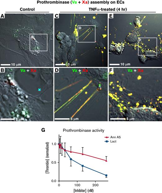 Topology-related assembly of prothrombinase complexes on TNF-α–activated HUVECs. Subconfluent HUVECs were treated with TNF-α (50 ng/mL, 4 hours) and then incubated with factor Va-Alexa 488, 10 nM (green) and 10 nM factor Xa-647 (red). They were then imaged, live, with differential interference contrast and confocal fluorescence. (A-B) Representative wide and enlarged views of a field of HUVECs with low levels of factor Va and Xa binding. Thin cellular projections did not have visible staining (arrow). (C-D) Representative wide and enlarged views of a field of HUVECs containing colocalized factors Va and Xa on filaments and filopodialike structures at the cell periphery. (E-F). Representative wide and enlarged views of a field of HUVECs showing colocalized binding of factor Va and Xa on punctate structures of the cell body. (G) HUVECs were cultured in 96-well plates in the presence of TNF-α. Prothrombinase activity was measured in a discontinuous assay with a chromogenic thrombin substrate. Prothrombinase activity was inhibited to a greater degree by lactadherin compared with annexin A5. Data are mean ± standard deviation for 2 experiments, each performed in triplicate.