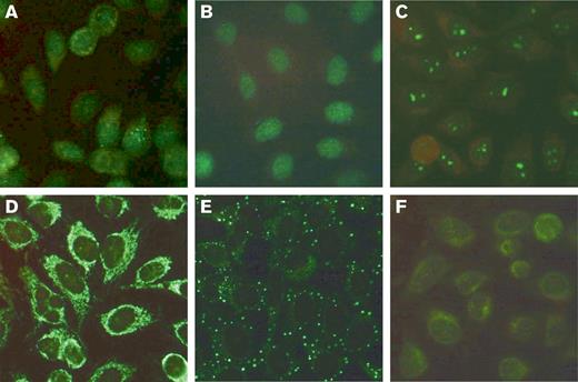 Representative HEp-2 immunofluorescent patterns of patients with AHA. (A) ANA (1:320) of nuclear speckled pattern with few nuclear dots in an 85-year-old male patient with FVIII:C of 2.2 IU/dL and an inhibitor of 4 BU/mL. (B) ANA (1:640) of nuclear homogeneous pattern in an 86-year-old male patient with FVIII:C of 2.4 IU/dL and an inhibitor of 9 BU/mL. (C) ANA (1:640) of nucleolar pattern in an 81-year-old female patient with FVIII:C of 2.5 IU/dL and an inhibitor of 104 BU/mL. (D) Cytoplasmic reticular, “mitochondrial” pattern (without ANA) in a 52-year-old female patient with FVIII:C of 4 IU/dL and an inhibitor of 71 BU/mL. (E) Cytoplasmic discrete dots/GW body-like pattern in a 73-year-old male patient with FVIII:C of <1 IU/dL and an inhibitor of 1.5 BU/mL. (F) Combined nuclear and cytoplasmic pattern (1:160) in a 73-year-old female patient with FVIII:C of 6 IU/dL and an inhibitor of 60 BU/mL. FVIII:C, factor VIII activity.