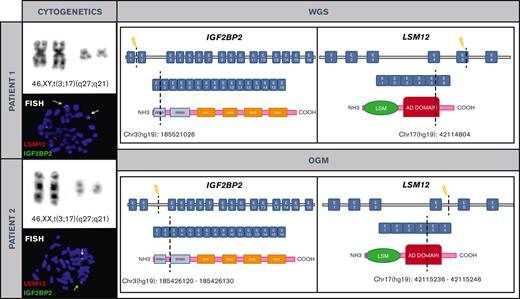 Cytogenetic and molecular characterization of t(3;17)(q27;q21)/IGF2BP2::LSM12 in both patients. Chromosomes and metaphase-FISH of both patients show t(3;17)(q27;q21)/IGF2BP2::LSM12 fusion (left). Dashed line indicates the DNA and domain structure breakpoints (LSM12: NM_152344 and IGF2BP2: NM_006548.6) revealed after WGS and OGM in both patients. Breakpoints at IGF2BP2 affect RNA recognition motif 1. The RNA recognition motifs have high affinity for RNA, determining the binding capacities of the RNA-binding proteins (RBPs) to RNA, play a central role in the stability of IGF2BP-RNA complexes, and coordinate the interactions between the complex and other RBPs. Breakpoints at LSM12 affect anticodon binding domain (AD). Its function consists of binding the anticodon of transfer RNA (right). COOH, carboxylic acid; E, exon; NH3, ammonia.
