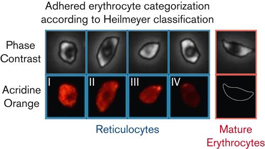 Adhered erythrocytes are categorized as reticulocytes or mature erythrocytes based on the fluorescence intensity. Heilmeyer classification groups reticulocytes into 4 groups, group 1 with dense, clumped reticulum, group 2 extended network of loose reticulum, group 3 scattered granules with residual reticulum, and group 4 scattered granules. Mature erythrocytes without nucleic acids are not visible in the fluorescent channel. The same classification and notation are used for distinguishing adhered reticulocytes and mature erythrocytes.