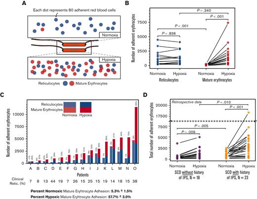 Reticulocyte and mature erythrocyte adhesion to laminin (LN) in normoxic and hypoxic microscale flow. (A) Staining of sickle erythrocytes for nucleic acids with acridine orange reveals the reticulocytes. Varying levels of reticulocyte (blue) and mature erythrocyte (red) adhesion under different physiologically relevant oxygenation conditions are shown. The partial oxygen saturation (SpO2) is greater than 95% under (i) normoxia and approximately 83% under (ii) hypoxia. (B) Comparison of adherent sickle erythrocytes under normoxia and hypoxia. Under normoxic conditions, adherent sickle erythrocytes are predominantly reticulocytes. Reticulocyte adhesion to LN under hypoxia was not significantly different from reticulocyte adhesion under normoxia. However, the contribution to overall adhesion by mature erythrocytes increased significantly under hypoxia. (C) Stacked and grouped column bars represent the adherent sickle erythrocyte types individually for patients. Shown above each column is the mature erythrocyte adhesion percentage. Minimal normoxic mature erythrocyte adhesion notably increased because of hypoxia and became the predominant contributor to total erythrocyte adhesion under hypoxia in 12/15 samples. Shown below patient identifiers are the reticulocyte percentages obtained from a clinical laboratory, and clinical reticulocyte percentages are not statistically associated (P=.162, linear regression) (D) Hypoxia enhanced total erythrocyte adhesion is associated with intrapulmonary shunting in subjects with HbSS SCD. Erythrocytes from both subject groups display a significant increase in adhesion under hypoxia compared with normoxia, and normoxic and hypoxic adhesion of erythrocyts are significantly different between the IPS and IPS unknown groups. Nno-IPS=18, NIPS=23. P values were calculated using the Mann-Whitney test and 1-way ANOVA for non-normal and normal data, respectively. Data are presented as mean ± SEM.