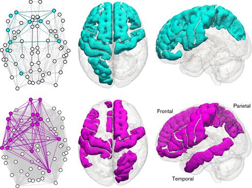 Topological and standard-space representations of the subnetworks differing between patients and control subjects for the streamline-weighted case (top, cyan) and the fractional anisotropy-weighted case (bottom, magenta). Left column: axial topological view of the whole network, with subnetwork nodes and edges colored. Edge opacity is proportional to weight. Middle column: axial view of the brain, with regions involved in the subnetwork colored. Right column: sagittal view of the brain, with regions involved in the subnetwork colored. The left of the brain is shown on the left in axial views; sagittal views are from the left.
