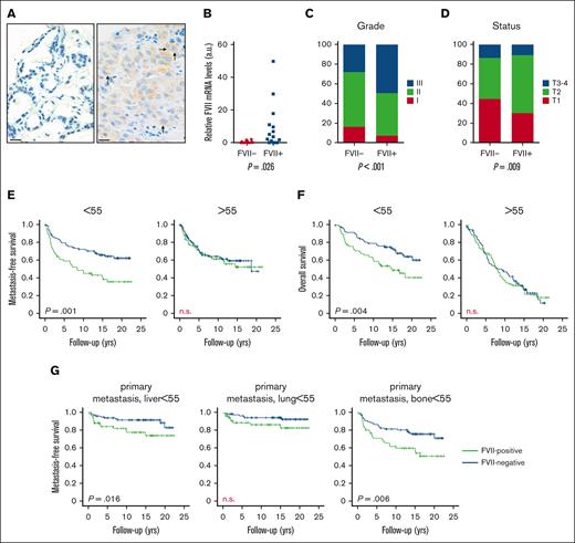 Tumor-expressed FVII expression is positively associated with breast tumor progression. (A) Representative image of a tissue microarray staining for FVII protein expression in a cohort of 574 breast tumors. (B) FVII mRNA expression was verified in 20 FVII− and 20 FVII+ tumor specimens. FVII expression is associated with grade (C) and T-status (D). (E) Metastasis-free survival in patients younger and older than 55 years. (F) Overall survival in patients younger and older than 55 years. (G) Association between FVII expression and the first-diagnosed site of metastasis.