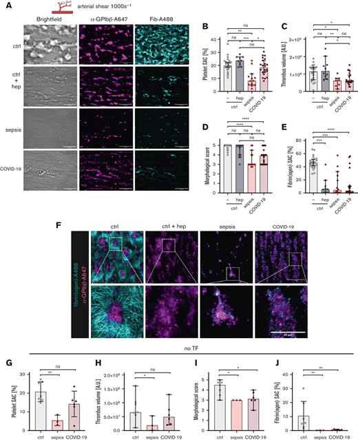 Robust thrombus formation despite anticoagulation in COVID-19. (A-J) Thrombus and fibrin formation were assessed under arterial shear (1000 s−1) using recalcified whole blood on collagen/TF (A-F) or collagen-coated spots (G-J). Samples were stained for platelets (α-GPIbβ-Alexa647, magenta) and fibrin(ogen) (cyan). SAC (%) of platelets (B and G), platelet fluorescence intensity in AUs (C and H), morphological score evaluated by 2 blinded investigators (D and I), and fibrin(ogen) SAC (E and J) are displayed. Representative images from 1 focal plane are depicted in panel A and scale bars indicate 50 μm. (F) Thrombi were imaged in 1 focal plane using confocal microscopy, scale bar in upper images indicates 50 μm and lower images indicates 25 μm. All graphs show median ± 95% CI. Differences were analyzed using the Kruskal-Wallis test. ∗P < .05, ∗∗P < .01, ∗∗∗P < .001, ∗∗∗∗P < .0001.