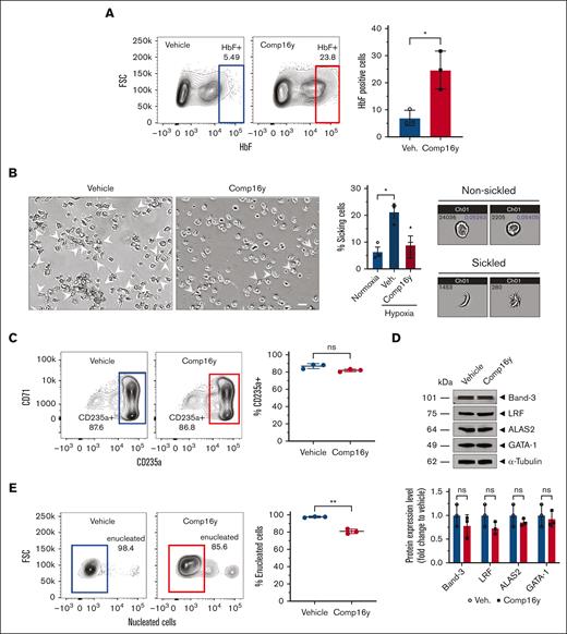 SGK1 inhibition induces fetal hemoglobin in CD34+ cells from sickle cell donors and protects from sickling. Comp16y increases HbF and prevents sickling in differentiated CD34+ cells from sickle cell donors. Treatment with Comp16y increases HbF-positive erythroid cells differentiated from SCD donor blood peripheral blood mononuclear cell and treated cells resist sickling triggered by hypoxia (2% oxygen). (A) Treatment with Comp16y (5 μM) increases HbF-positive cells by day 14 of differentiation in representative flow cytometry plots from a single donor (left) and quantification of data from 3 independent sickle cell donors confirm a significant increase in HbF-positive cells (right) (3.5-fold increase). Two-tailed t test, ∗P < .05 (N=3). (B) Sickling under normoxia (20% oxygen) or hypoxia (2% oxygen) was assessed with fully differentiated CD34+ cells from SCD donor PBMC with and without SGK1 inhibition. Representative microscopic images of 21-day differentiated SCD donor CD34+ cells under hypoxia following differentiation in the presence of Comp16y (5 μM) or 0.1% dimethyl sulfoxide vehicle control (left) shows decreased sickling following SGK1 inhibition (2.1-fold decrease) (scale bar is 20 μm). Arrows indicate abnormal shaped cells. Similar results obtained for 3 independent donors. Sickle cell imaging flow cytometry assays were performed using the Amnis ImageStream and cell shape modification was quantitated using IDEAS software to quantify the percentage of sickling cells (middle) as described previously.21 Representative images by sickle cell imaging flow cytometry assays (right) of cell populations under normoxia gated as under normoxia (nonsickled) or hypoxia (2% oxygen) gated as sickled (60× magnification). Mean ± standard error of the mean (N = 3 independent HbSS SCD donors) and ∗P < .05 (two-tailed t test). (C) Flow cytometric analysis of CD235a+ cells on day 21 indicates normal differentiation of CD34+ cells treated with Comp16y (5 μM). Panels on left are representative flow cytometry plots from a single donor and quantification of data from 3 independent sickle cell donors show no significant decrease in CD235+ cells (middle). Two-tailed t test, ns = not significant (N = 3). Western blot analysis and quantification of selected erythroid differentiation markers (Band-3, LRF, ALAS2, GATA-1) on day 14 are all similar between Comp16y and vehicle treated SCD CD34+ cells when normalized to α-tubulin, confirming normal erythroid cell differentiation. A representative western blot (right top) and statistical analysis of all data (right bottom) are shown. Two-tailed t test, ns = not significant, N = 3. (D) Enucleation observed for fully differentiated SCD CD34+ cells on day 21 for both Comp16y and vehicle treatments shows a minor but significant effect of SGK1 inhibition on enucleation. This minor decrease in enucleation is consistent with normal erythroid differentiation. Two-tailed t test, ∗∗P < .01, N = 3.