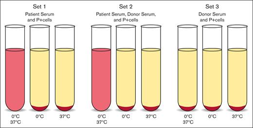 DL test.12,13 This test is diagnostic of PCH and can be performed with patient serum or whole blood although serum is preferred. Testing requires receipt of sample at 37°C to prevent binding of antibodies to patient cells. Three sets of 3 tubes are prepared as follows: (1) patient serum, (2) patient serum and normal serum, and (3) normal serum only. Normal serum is added to patient serum to supplement complement factors, and normal serum alone should act as a negative control. P-antigen–positive reagent cells are added to each tube. The first tube of each set is incubated in ice at ∼0°C and then brought to 37°C, the second tube of each set is incubated in ice only, and the third tube is incubated at 37°C only. Hemolysis in the first tube of sets 1 and 2 is a positive test.