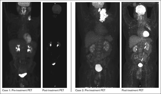 PET images pre- and post treatment.