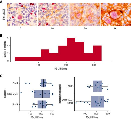 Baseline PD-L1 expression and correlation to single-agent pembrolizumab response. (A-C) PD-1 pathway correlates baseline PD-L1/PAX-5 staining by immunohistochemistry (A), PD-L1 H score distribution across a cohort of 29 patients (B), and association between PET responses to single-agent pembrolizumab and PD-L1 H score in baseline biopsy specimens (C).