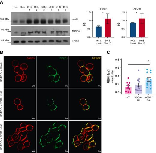 Band 3 and ABCB6 overexpression in plasma membrane protein of RBCs from patients with DHS and PIEZO1–band 3 colocalization. (A) Left: representative immunoblot of RBC membrane proteins showing band 3 and ABCB6 protein expression normalized to β-actin in the patients DHS1, DHS2, DHS3, DHS4, DHS5, and DHS6 compared with HCs (2 pools of HCs, each of n = 3). Right: densitometric analysis of 3 representative western blotting is shown for band 3 and ABCB6 proteins. Data are presented as mean ± standard deviation; ∗P < .05; ∗∗P < .01 (Student t test). (B) Representative confocal imaging by ZEISS LSM 980 Airyscan 2 of HC RBCs treated with vehicle (upper panel) compared with HC RBCs treated with 2.5 μM Yoda1 (10 minutes) (middle panel) and HC RBCs treated with 2.5 μM Yoda1 (20 minutes) (lower panel). Rabbit anti-PIEZO1 antibody is shown in green, mouse anti–band 3 is shown in red. The overlapping of both signals (MERGE) is shown on the right (yellow). (C) Quantification by Pearson correlation of PIEZO1–band 3 colocalization in untreated HC RBCs, HC RBCs + 2.5 μM Yoda1 (10 minutes), and HC RBCs + 2.5 μM Yoda1 (20 minutes) is shown. Data shown are the means of 12 independent acquisitions ± standard error of the mean; P < .05 for trend (ANOVA test), ∗P < .05 (post hoc correction by Tukey multiple comparisons test).