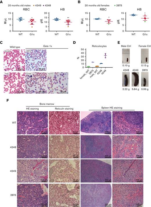 Hematopoietic phenotype of aged Gata1s mice. PB analysis of RBC count and Hb level from WT and Gata1s (G1s) 20-month-old male (A) and female (B) Gata1s mice. The values of animals #4248, #4249, and #2873 are highlighted in different colors. (C) Photos of PB smears showing the increased reticulocytes in aging Gata1s (G1s) mice highlighted in panels A and B. Arrows indicate RBCs with abnormal morphology. Scale bars represent 50 μm. (D) Percentage of reticulocytes in the PB in panel C was determined by enumerating total RBCs and reticulocytes in 3 different fields. (E) Photos of enlarged spleens from animal #4248, #4249, and #2873 and 2 WT controls. Bars represent 1 cm. (F) Photomicrographs of hematoxylin and eosin (HE)– or reticulin-stained BM and spleen sections from mice in panel E. Scale bars represent 100 μm (left) and 50 μm (right) in BM sections, and represent 500 μm (left) and 100 μm (right) in spleen sections. Mean ± SD are shown in graphs, age = 20 months. ∗P ≤ .05, ∗∗P ≤ .01 by unpaired Student t test.