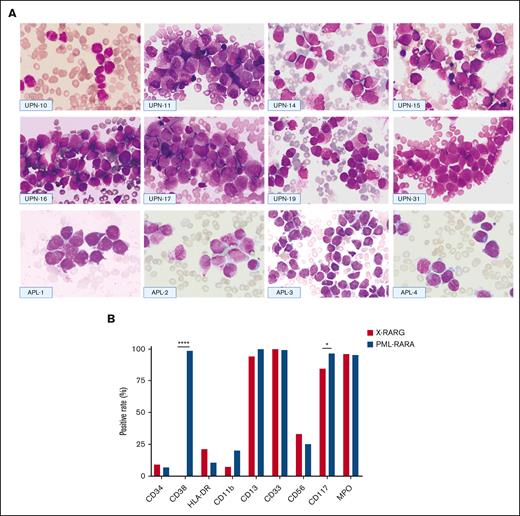 Morphologic and immunophenotypic features of patients with AML with RARG rearrangement. (A) Morphologic features of 8 cases with RARG rearrangement (top and middle) and 4 cases with PML::RARA (bottom). Most blasts had hypergranular cytoplasm (UPNs 11, 15-17, and 31 and APL-1, -2, and -4) or hypogranular cytoplasm (UPNs 10, 14, and 19 and APL-3). Auer rods were also present in some cases (UPNs 10 and 14 and APL-1 and -2). Most blasts harbored an irregular round, oval, or bilobed nucleus that was strongly suggestive of French-American-British classification type M3. (B) Comparison of immunophenotyping features between patients with RARG rearrangement (X::RARG, n = 34) and those with PML::RARA (n = 221). The expression of surface markers was not different between the 2 groups, except for CD38 (0 vs 98.5%; P < .0001) and CD117 (84.4% vs 96.7%; P = .01).