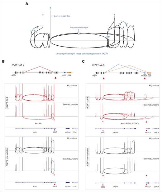 Identification of representative IKZF1 deleted cases by splice junction track analysis. (A) Schematic representation of Sashimi plot for 1 IKZF1 nondeleted case displaying all expected arcs connecting IKZF1 exons. The vertical peaks represent coverage depth on IKZF1 exons. Arcs represent splice junctions that connect exons, and the numbers on curved lines show the junction read depth that split across the junction. (B) Schematic view and Sashimi plots obtained in the IGV software for a representative IKZF1 Δ4-7 case (red) displaying abnormal splice junction arcs connecting exon 3-8, which it is not seem in the IKZF1 nondeleted case (black). The upper panel displays all exon-exon junctions. The lower panel display selected exon junctions, which distinguish a particular IKZF1 deletion. This is accomplished in IGV by clicking on the specific exon, as indicated by the red arrowhead. (C) Schematic view and Sashimi plots for a representative IKZF1 Δ4-8 case (red) displaying the abnormal splice junctions connecting exon 3 to downstream genes FIGNL1 and DDC. Note that the abnormal splice junction arcs are only seen in IKZF1 deleted cases. Results for the whole group of patients are summarized in supplemental Figure 6 and supplemental Table 6. Genomic coordinates plotted on the last track of each panel correspond to RefSeq, Hg19.