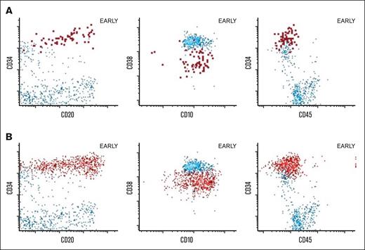 Flow cytometric features of B-ALL-like cell populations arising during lenalidomide therapy. BM flow cytometry dot plots depicting abnormal immature B-cell populations arising during lenalidomide therapy, which ultimately resolved with holding lenalidomide. Plots reflect normal case (blue dots) with abnormal immature B cells (A) (red, emphasized) in patient #15 showing abnormally increased CD20 and CD34 with abnormally decreased CD38 and abnormal immature B cells (B) (red dots) in patient #10 with similar abnormal phenotype.