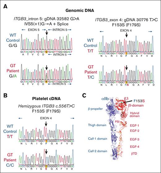 Mutation analysis of ITGB3 showed that a novel mutation F153S (F179S) in exon 4 and an intronic mutation IVS5(+1) G>A are located on different alleles. (A) Electropherograms of gDNA sequencing reveal a previously reported splice site mutation in intron 5: IVS5(+1) G>A (left) and a novel missense mutation in exon 4 c.556T>C encoding F153S (F179S numbering with cleaved propeptide) (right). The precise nucleotide of each mutation is indicated by a heavy arrow (n = 2 in triplicate with forward and reverse primers). (B) Platelet cDNA sequencing analysis detected only 1 transcript with ITGB3 mutation: c.556 T>C (F153S or F179S). Sequence analysis primary cDNA (n = 1 in triplicate using forward and reverse primers). The cDNA PCR products were also cloned into a plasmid and sequence analysis confirmed GT hemizygous expression (n = 20 clones using forward and reverse primers). (C) A molecular ribbon diagram designed with PyMol software depicting an extended conformation of αIIbβ3 generated from the crystal structure in the PDB 3fcs shows the location of F153Sβ3 as green sticks and dots.31 Metal ions are shown as blue spheres. Disulfide bonds are shown as yellow sticks.