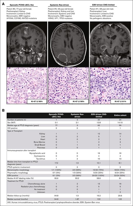 Clinical and pathologic features of the 3 identified types of PTLD involving the CNS. (A) Preoperative T1-weighted postcontrast magnetic resonance imaging and hematoxylin and eosin–stained sections from representative patients with sporadic PCNS-LBCL–like, systemic Ras-driven, and EBV-driven CNS-limited PTLD-CNS showing intraparenchymal mass lesions with contrast enhancement and significant edema in the surrounding white matter. Ki-67 LI is shown. (B) Summary of clinical and pathologic features of the multiinstitutional cohort of patients with PTLD-CNS.