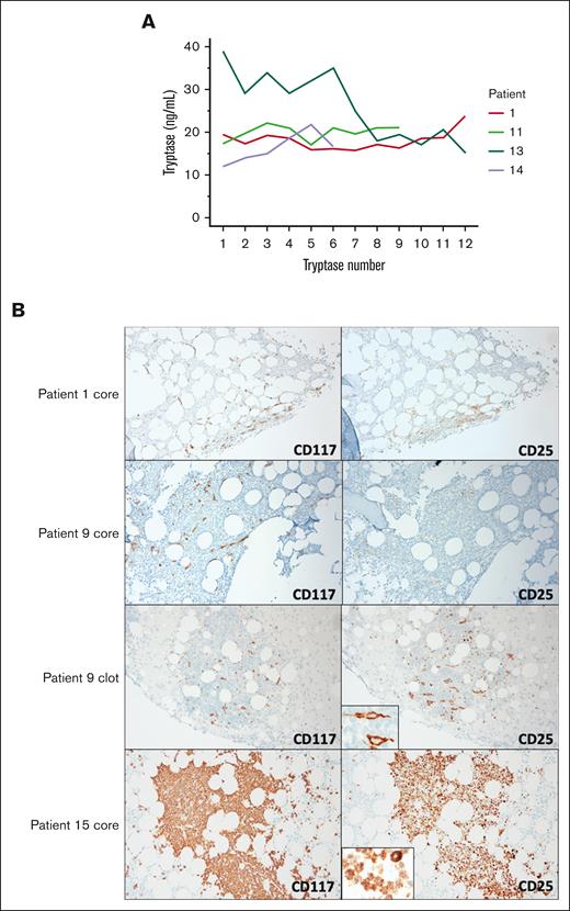(A) BST values over time in 4 patients with indolent SM. Patients 1, 11, 13, and 14 are shown in whom some BST values are above and others fall below 20 ng/mL. Patient 6 is not shown because tryptase is not a WHO minor criterion in those diagnosed with SM-AHN. There was no acute allergic reaction, renal injury, or cytoreductive treatment used at the time of BST measurement at any timepoint. (B) CD117 and CD25 IHC are shown for patients 1 and 9 with indolent SM as well as patient 15 with WDSM. Original CD25 IHC core biopsy slides for patients 1 and 9 were negative (not shown). Patients 1 had new core slides cut and stained for CD117 and CD25 IHC at a second pathology lab and results showed colocalization of CD25 expression with CD117-positive cells. Patient 6 (not shown) had results similar to that of patient 1. Patient 9 had new core and clot slides cut and stained for CD117 and CD25 IHC at a second pathology lab and results showed colocalization of CD25 expression with CD117-positive cells (see insert) in the clot but not the core. The discordance between the core and the clot CD25 IHC for patient 9 suggested that the core biopsy decalcification procedure contributed to a false-negative result. Patient 15 with WDSM had large aggregates of round MCs. CD25 colocalized to CD117-positive cells in a cytoplasmic rather than plasma membrane distribution (see insert).