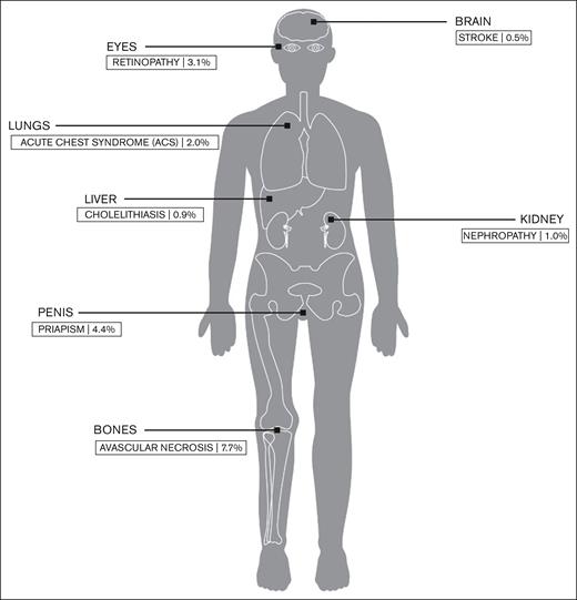 Prevalence of common SCD complications within the patient population with HbSC disease at the Ghana Institute of Clinical Genetics.
