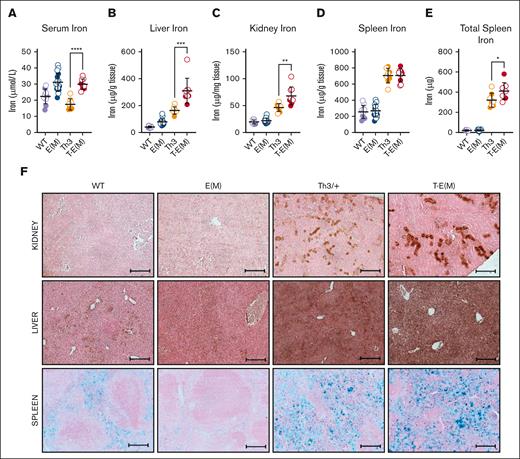 ERFE overexpression exacerbates iron overload in thalassemic mice. Mice generated from Th3 × E(M) breedings were analyzed at 16 weeks of age. Males are depicted as closed circles and females as open circles. (A-E) Nonheme iron concentrations were assessed in (A) serum, (B) liver, (C) kidney, and (D) spleen: (E) total splenic nonheme iron, (F) iron visualized in formalin-fixed paraffin-embedded sections sections of the kidney (top), liver (middle) and spleen (bottom) from male 16-week-old mice using diaminobenzidine-enhanced Perls’ stain (kidney and liver) and Perls’ stain (spleen). Original magnification ×10 (F). Scale bars represent 200 μm (F). (A-F) P values were assessed by two-tailed unpaired t test (∗P < .05; ∗∗P < .01; ∗∗∗P < .001; ∗∗∗∗P < .0001) between the Th3 and T-E(M) groups only.