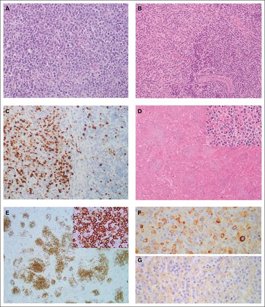 Morphological and immunohistochemical features of SMZL-T. (A) Case SMZL058T showing a lymph node with a diffuse proliferation composed of large lymphocytes with a centroblastic appearance (hematoxylin and eosin stain, original magnification ×20). (B-C) Detail of case SMZL07T showing the interphase between a transformed area (left) and an area with remnant marginal splenic B-cell lymphoma (right). In panel B, hematoxylin and eosin stain (original magnification ×20); and in panel C, immunohistochemical staining for Ki67 showing the different proliferative index between both areas (original magnification ×20). (D-G). Case SMZL012T showing the spleen infiltrated by a lymphoid proliferation arranged in a nodular growth pattern, original magnification ×4 (D), constituted of large, atypical cells (inset, original magnification ×40). (E) These cells were positive for CD20 (original magnification ×2; inset, original magnification ×20), (F) had Kappa light chain restriction (original magnification ×40), and (G) were negative for Lambda light chain (original magnification ×40).