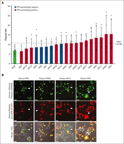 Human ITP serum–triggered macrophage phagocytosis of platelets in vitro. (A) Serum from patients with ITP were evaluated for their potential to trigger THP-1-CD16A macrophage phagocytosis of platelets. Each serum was evaluated over 4 to 5 independent experiments. As a negative control, sera from healthy laboratory donors (NHS) were used to opsonize platelets (4 unique NHS donors used over 9 independent experiments). Phagocytosis was performed blinded to patient clinical information and all characterization of ITP sera to avoid bias. Only ITP sera negative for MHC class I alloantibodies (n = 19) are displayed. Phagocytosis was performed as described in the “Methods” and quantified from fluorescent photomicrographs. Phagocytic index: number of phagocytosed platelets per 100 counted macrophages. Dashed line indicates the phagocytic index mean of NHS plus 2 SD . Error is presented as mean ± 1 SD. (B) Example photomicrographs of THP-1-CD16A macrophages after incubation with human platelets incubated human ITP serum. White arrows point toward example macrophages with phagocytosed platelets. Platelets were labeled with the cytoplasmic dye CMFDA (green, top row). External (nonphagocytosed) platelets were identified after phagocytosis using an AlexaFluor 647 (AF647)-conjugated anti-GPIX antibody (red, middle row). Merged fluorescence and DIC images are shown in the bottom row. Areas of red and green colocalization in the merge appear as yellow-orange. Scale bar: 10 μM. Photomicrographs were taken by spinning-disk confocal microscopy under 63× objective oil immersion (numerical aperture 1.47) with DIC and laser fluorescence (488, 647) channels on a Quorum multimodal imaging system equipped with 50 μm pinhole spinning disk and ORCA-Flash 4.0 V2 PLUS sCMOS camera. At least 4 images at distinct locations were taken near the center of each coverslip with Z-stacking every 0.33 μm. Z-stacked images were 3D reconstructed for analysis using Imaris v8.0.2.