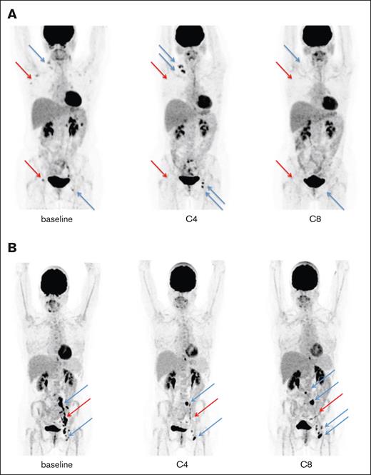 Illustration of the 2 IR and their evolution. (A) At baseline, 1 case harboring metabolic lymph nodes in the right supraclavicular, axillary, and inguinal areas at baseline (blue and red arrows). At C4, a new left inguinal lesion appeared, with an increase in the existing right supraclavicular lesions (blue arrows) while metabolic regression was observed (red arrows), showing an IR2 perthe LYRIC criteria. At C8, no metabolic activity was observed in the supraclavicular, axillary, or inguinal areas, indicating a complete metabolic response while retrospectively setting the PP at C4. (B) At baseline, 1 case harbored metabolic nodes in the left iliac and inguinal areas at baseline (blue and red arrows). At C4, 2 lesions showed increased metabolic uptake in the left iliac and inguinal areas, without morphological modification (blue arrows), whereas metabolic regression was observed in the other lesions (red arrow), showing an IR3 per the LYRIC criteria. At C8, there was an increase of metabolic lesions in the para aortic, left iliac, and left inguinal areas pointing to a “true” progression.