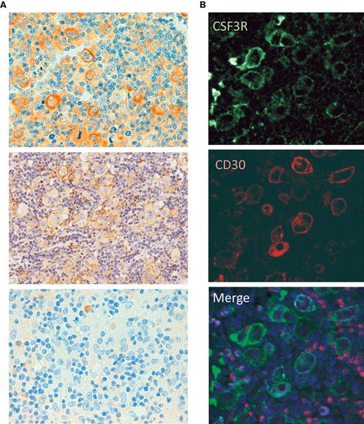 CSF3R protein expression in primary tumors. (A) Representative examples of CSF3R in HL primary tumors, with strong, faint, and negative IHC expression. (B) mIF for CSF3R (green) and CD30 (red).