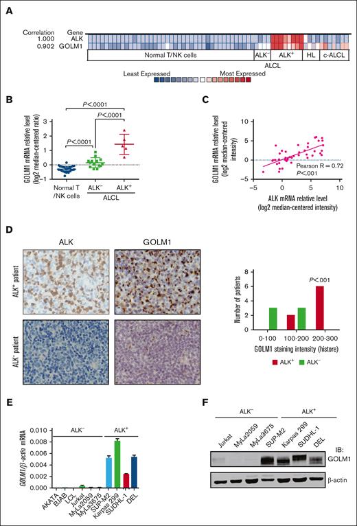 GOLM1 is overexpressed and correlates with ALK in human ALK+ ALCL. (A) Correlation of the expression levels of GOLM1 and ALK. Colors are z score normalized to depict relative values within rows. (B) The GOLM1 transcript (calculated as log2 median-centered intensity) as studied in Human Genome U133 Plus 2.0 Array platform in samples from patients with ALK+ ALCL from the Oncomine database (Eckerle lymphoma) and compared with normal T lymphocyte/NK cells and ALK- ALCL. (C) Correlation between mRNA transcript levels of ALK and GOLM1 in human samples from patients with ALCL from Oncomine database. (D) A representative image of immunohistochemistry analysis to show the expression of GOLM1 in ALK+ ALCL, but not in samples from patients with ALK- ALCL. Original magnification 200×. (E-F) GOLM1 mRNA and protein expression in the ALK+ ALCL cell lines DEL, SUP-M2, Karpas 299, SUDHL-1, and other cell lines was evaluated by qPCR and western blotting, respectively. Data, presented as the mean ± SD, are representative of 3 independent experiments. NK, natural killer; SD, standard deviation.