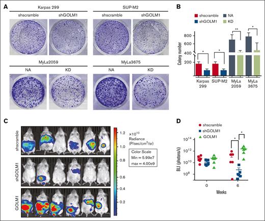 GOLM1 promotes tumor growth in vitro and in vivo. (A-B) The anchorage-independent growth of ALCL cells. Cells were subjected to soft agar colony formation assay individually. The colonies were stained by crystal violet and counted by using Image J software. Data from triplicate experiments were presented as mean ± SD (∗P < .05, ∗∗∗P < .001, two-tailed Student t test). (C-D) GOLM1 contributes to ALCL tumor growth in a xenograft mouse model. The tumor burden of NOD/SCID mice intraperitoneally engrafted with 2 × 107 SUP-M2-luc cells with stably expressing GOLM1, GOLM1 knockdown, or scramble control at weeks 0 and 6 were analyzed by the intensity of bioluminescence signal. Data, presented as individual mice, are representative of 3 independent experiments. NOD, nonobese diabetic; SCID, severe combined immunodeficiency; SD, standard deviation.