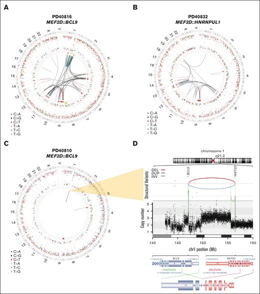 Complexity of MEF2D genomes in B-ALL. Genomic landscape of MEF2D-rearranged B-ALL. (A-B) Circos plots showing high SV burden in the 2 MEFDr cases with chromothripsis. The circos plot shows 4 concentric panels, and the outermost ring shows the chromosome ideogram. The second ring shows the intermutation distance for all SNVs color-coded by the pyrimidine partner of the mutated base (C>A, blue; C>G, black; C>T, red; T>A, gray; T<C, green; and T>G, pink). The third ring shows small insertions (dark green) and deletions (dark red). The fourth ring shows copy number change gains (green) and losses (red). Intra- and interchromosomal SVs are shown by arcs describing translocations (black), inversions (blue), deletions (red), and duplications (green). Circo plot (C) and locus plot of 1q21 (D) showing the “quiet” global SV burden and complex causative local SV event in an MEF2D::BCL9 case. In the locus plot in panel D are shown SV events as arcs between 2 breakpoint loci, with the color denoting the type of SV (top); the absolute copy number (middle); and the 2 causative SVs (inversion and deletion) overlaying the transcript structure of BCL9 and MEF2D (bottom). DEL, deletion; DUP, duplication; INV, inversion.