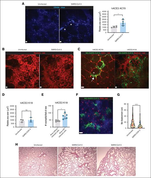 Vascular dynamics in the lungs of mice infected with SARS-CoV-2. Mice were infected with 2.5 × 104 pfu NG-SARS-CoV-2 via IN. (A) IVM images (original magnification ×20) of the lungs of hACE2 AC70 mice uninfected or infected with NG-SARS-CoV-2 showing platelets (anti-CD49b, blue) in the vasculature (day 6 after infection). Scale bar, 12 μm. The graph represents the quantification of the area covered by platelets per FOV after IVM. (B) IVM images (original magnification ×20) of the lungs of hACE2 AC70 mice uninfected or infected with NG-SARS-CoV-2 after the administration of 70 000 MW dextran-rhodamine. Scale bar, 12 μm. (C) IVM images (original magnification ×20) of the lungs of hACE2 AC70 and hACE2 K18 mice infected with NG-SARS-CoV-2, showing areas with infected cells (green). The asterisk indicates the epithelial lining the alveoli and the filled arrow indicates cells lining the capillaries. Scale bars, 34 μm (left) and 12 μm (right). (D) Quantification of the area covered by platelets per FOV after IVM in hACE2 K18 mice uninfected and infected with NG-SARS-CoV-2 (day 6 after infection). (E) Quantification of the number of neutrophils per FOV after IVM in hACE2 K18 mice infected with NG-SARS-CoV-2 (day 6 after infection). Comparison between FOVs without infected cells vs FOVs with infected cells. Each dot in the graphs represents 1 FOV. (F) IVM image (original magnification ×10) of the lungs of hACE2 AC70 mice infected with NG-SARS-CoV-2 showing PKH-alveolar macrophages (AMs) (red) in the alveolar space (day 6 after infection). Scale bar, 50 μm. (G) Quantification of AM displacement in uninfected and infected mice. Colors represent individual mice. n = 3 mice per group. (H) Hematoxylin and eosin staining of lung sections from hACE2 AC70 mice uninfected and infected with NG-SARS-CoV-2. Data (as applicable) are represented as mean ± SD. Unpaired Student t test was performed for statistical analysis. ∗P < .05; ∗∗∗∗P < .001.