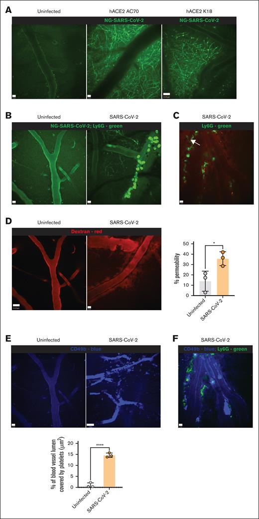 Brain pathology in transgenic mice infected with SARS-CoV-2. Mice were infected with 2.5 × 104 pfu NG-SARS-CoV-2 via IN. (A) IVM images (original magnification ×20) of the brains of hACE2 AC70 and hACE2 K18 mice uninfected and infected with NG-SARS-CoV-2 showing infected neurons (green) (day 5 after infection). Scale bars, 12 μm (left and middle), 20 μm (right). (B) IVM images (original magnification ×20) of the brains of hACE2 AC70 mice uninfected and infected with NG-SARS-CoV-2. Anti-Ly6G (AL488) was injected IV during the acquisition of the image to make sure the neutrophils were not infected. Scale bars, 12 μm. (C) IVM image (original magnification ×20) of the brain of hACE2 AC70 mice infected with NG-SARS-CoV-2. Anti-Ly6G (AL488) was injected IV during the acquisition of the image showing neutrophils (green) (day 5 after infection). The arrow indicates a neutrophil entering the brain parenchyma. Scale bar, 12 μm. (D) IVM images (original magnification ×20) of the brains of hACE2 AC70 mice uninfected and infected with NG-SARS-CoV-2 after the administration of 70 000 MW dextran-rhodamine. Scale bars, 23 μm (left) and 12 μm (right). The graph represents the percentage of permeability of the blood vessels in the brain. (E) IVM images (original magnification ×20) of the brains of hACE2 AC70 mice uninfected and infected with NG-SARS-CoV-2 showing platelets (anti-CD49b, blue) (day 5 after infection). Scale bars, 12 μm (left) and 25 μm (right). The graph represents the quantification of the % of the blood vessel lumen covered by platelets. (F) IVM images (original magnification ×20) of the brains of hACE2 AC70 mice infected with NG-SARS-CoV-2 showing platelets (anti-CD49b, blue) and neutrophils (anti-Ly6G, green) in the vasculature (day 5 after infection). Anti-Ly6G (AL488) was injected IV during the acquisition of the image to make sure the neutrophils were not infected. Scale bar, 12 μm. Data (as applicable) are represented as mean ± SD. Unpaired Student t test was performed for statistical analysis. ∗P < .05; ∗∗∗∗P < .001.