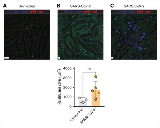 Mice infected with SARS-CoV-2 showed subtle effects in the liver microvasculature. Mice were infected with 2.5 × 104 pfu NG-SARS-CoV-2 via IN. IVM images (original magnification ×25) of the livers of hACE2 AC70 mice not infected (A) and infected (B-C) with NG-SARS-CoV-2 showing platelets (anti-CD49b, blue) and neutrophils (anti-Ly6G, red) (day 5 after infection). Scale bars, 23 μm (left), 10 μm (middle and right). The graph represents the quantification of the area covered by platelets per FOV after IVM. Data (where applicable) are represented as mean ± SD. ns, not significant. Unpaired Student t test was performed for statistical analysis.