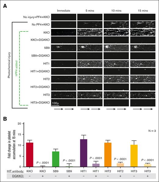Effect of DGKKO on HIT thrombosis in a microfluidic system. (A) Representative images over a 15-minute window of flow through the channels from 1 of 3 independent studies showing platelet accumulation (white aggregates) on the endothelial lining. Scale bar is included, and arrows at the bottom indicate direction of flow. In this assay, optimal platelet adhesion occurs using human umbilical vein endothelial cell–lined channels subjected to photochemical injury by hematoporphyrin, followed by perfusion of whole blood supplemented with PF4 and HIT monoclonal (KKO and 5B9) or polyclonal (patient-derived) antibodies. The effect of DGKKO added 15 minutes after HIT antibody–induced activation is shown for each monoclonal or polyclonal antibody used. Note that KKO by itself led to platelet accumulation on injured endothelium, as previously noted,21 likely because of the presence of hPF4 released from the platelets. (B) Quantitative analysis of platelet adhesion showing mean ± 1 SEM of 3 independent experiments. P values were determined using 2-way Student t test comparing platelet accumulation in the absence of DGKKO with that in the presence of DGKKO.