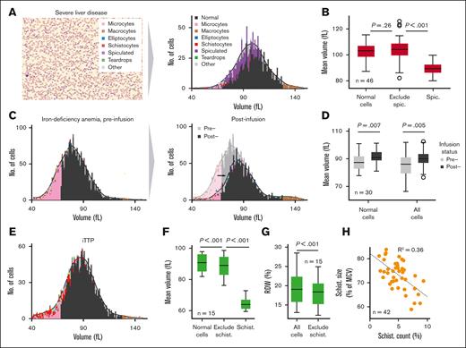 RBC-diff enables the estimation of single-cell volume-morphology distributions. (A) Red cell volume distribution across different RBC morphologies, as estimated from a peripheral smear using RBC-diff. (B) The average estimate cell volume across 46 preoperative patients who underwent liver transplantation for normal cells, spiculated cells, and all cells except spiculated. (C) Red cell volume-morphology distribution in a patient with iron-deficiency anemia (IDA) before and after intravenous iron infusion. (D) Mean cell volume of 30 patients with IDA before and after infusion for all cells and only normal cells. (E) Red cell volume-morphology distribution for a patient with iTTP near the point of ADAMTS13 testing. (F) Mean cell volume of patients with 15 iTTP for normal cells, all cells except schistocytes, and schistocytes. (G) Estimated mean RDW for 15 patients with iTTP for all cells after exclusion of schistocytes. (H) Association between the mean size of schistocytes (relative to the average cell size) and schistocyte count across patients with 15 iTTP (42 smears in total) with schistocyte counts <10%. All significance levels a 2-sample t test. IDA, iron-deficiency anemia.