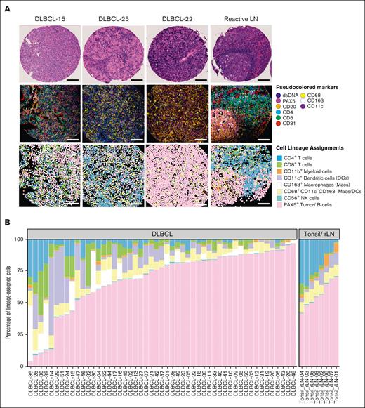 The DLBCL TIME is heterogeneous. (A) Representative FOVs from 3 DLBCLs NOS and 1 reactive lymph node (rLN) demonstrating the heterogeneity of the TIME by hematoxylin and eosin staining (H&E) (top), MIBIscope pseudoimages colored per the indicated biomarkers (middle), and cell lineage maps colored per the indicated cell lineages (bottom). Bars represent ∼100 μm distance from 500 μm2 FOVs; digitized H&E visualized at an objective magnification ×4. (B) Percentage of lineage-assigned cells that are tumor cells or one of the indicated immune cell lineages from 51 DLBCLs and 8 rLN/tonsil controls colored as in panel A. Data are aggregated from 3 FOVs per case for most cases and a single FOV from controls. Cells without a defined cell lineage were classified as “other” and excluded. Data from individual FOVs are presented in supplemental Figure 2A.