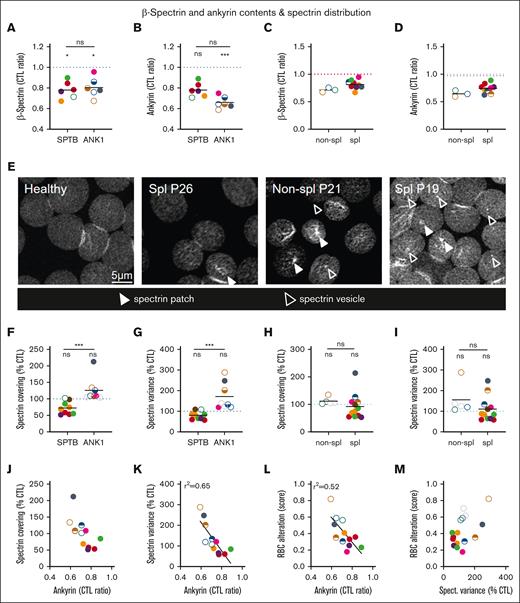 The ANK1 content and the SPT membrane distribution are differentially affected by the mutation but not by splenectomy and inversely and slightly correlate together and with the RBC alteration score. RBCs from patients, either spl (filled circles or semifilled circles for intrafamily comparison) or nonspl (open circles), and RBCs from CTLs (dark blue dotted line, CTL ratio or % CTL) or a healthy spl adult donor (red dotted line) were compared for SPTB and ANK1 content (A-D) and membrane SPTB coverage and heterogeneity (E-I). Statistics are indicated above the patient cohorts for the comparison with CTL values and above a horizontal line for comparison between the 2 patient cohorts. (A-D) SPTB and ANK1 membrane association evaluated by mass spectrometry on ghosts (2 independent experiments; see Figure 3 for volcano plots). Data are presented based on either mutation (A-B) or splenectomy (C-D). (E-I) SPT occupancy and heterogeneity. RBCs were spread onto PLL-coated coverslips and SPT was immunolabeled and observed via confocal microscopy. (E) Representative images (filled arrowhead, SPT-enriched patch; open arrowhead, SPT-enriched vesicle). Scale bar, 5 μm. In panels F-I, SPT occupancy was normalized to RBC membrane area (means of 2-7 independent experiments per patient; Kruskal-Wallis tests followed by Dunn post hoc). Data are presented based on either mutation (F-G) or splenectomy (H-I). (J-K) Relations between the ANK1 levels and the SPT coverage and variance. (L-M) Relations between the RBC alteration score from Figure 1N and the ANK1 levels or the SPT variance.