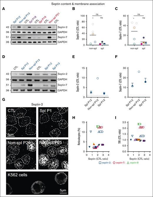 The increased septin content in spherocytosis is largely restored upon splenectomy and septin-2 associates with the RBC surface. RBCs from patients, either spl (filled circles or semifilled circles for intrafamily comparison) or nonspl (open circles), and RBCs from CTLs were compared for septin content (A-F) and membrane distribution (G). Statistics are indicated above the patient cohorts for the comparison with CTL values and above a horizontal line for comparison between the 2 patient cohorts, respectively. (A-F) Septin-2 and -7 ghost membrane association determined by western blotting. Representative western blots comparing different patients with healthy donors (A) and P13 before and after splenectomy (D). (B-C,E-F) Quantification: data were first expressed as ratio to glyceraldehyde-3-phosphate dehydrogenase (GAPDH) (loading control), then as ratio of P to CTL (Kruskal-Wallis test in panels B-C; means ± standard deviation of 1 experiment in panels E-F). (G) Septin-2 immunolabeling. Scale bar, 5 μm. RBCs were spread onto PLL-coated coverslips, fixed/permeabilized in ice-cold methanol and Triton X-100, and immunolabeled for septin-2. K562 cells were used as positive controls. Representative images of 2 independent experiments. (H-I) Correlation between septins and reticulocyte count presented in supplemental Figure 1E or Transferrin receptor (TfR) content presented at Figure 6K. Linear regressions were indicated only if r2 > 0.5.