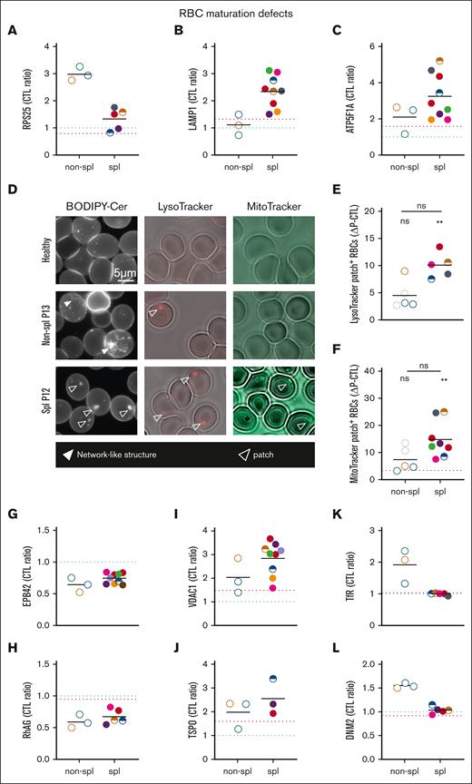 The presence of ER proteins and remnants in RBCs of nonspl patients contrasts with lysosome and mitochondria proteins and remnants in RBCs of spl patients. RBCs from patients, either spl (filled circles or semifilled circles for intrafamily comparison) or nonspl (open circles), and RBCs from CTLs (dark blue dotted line or CTL ratio or ΔP–CTL) or a healthy splenectomized donor (red dotted line) were compared for membrane association of proteins of the ER-ribosomes (A), lysosomes (B), or mitochondria (C) and for the presence of organelle remnants (D-F). Scale bar represents 5 μm in panel D. Statistics are indicated above the patient cohorts for the comparison with CTL values and above a horizontal line for comparison between the 2 patient cohorts, respectively. (A-C) Membrane ghost association of ribosomal protein S25 (RPS25), lysosomal-associated membrane protein 1 (LAMP1) and ATP synthase F1 subunit alpha (ATP5F1A), respectively, enriched in ribosomes, lysosomes, and mitochondria and determined by proteomics (statistical analysis and additional examples in supplemental Figure 3). (D-F) Organelle labeling. RBCs spread on PLL-coated coverslips were labeled with BODIPY-ceramide (Cer), LysoTracker, or MitoTracker and observed by fluorescence microscopy (LysoTracker was maintained during observation). (D) Representative images. Open and filled arrowheads, patches, and network-like structures, respectively. (E-F) Quantification of RBCs presenting LysoTracker- or MitoTracker-positive patches expressed as percentage of the total RBC population and then as ΔP–CTL (mean of 1-3 and 1-7 independent experiments perpatient in panels E and F, respectively; Kruskal-Wallis tests followed by Dunn post hoc). (G-L) Membrane ghost association of band 4.2 (EPB42), Rh-associated glycoprotein (RhAG), voltage-dependent anion channel 1 (VDAC1), translocator protein (TSPO), Transferrin receptor (TfR) and DNM2 (dynamin), respectively, involved in cytoskeleton anchorage complexes (G-H), mitophagy (I-J), and endocytosis (K-L) and determined by proteomics (for volcano plots, see supplemental Figure 3).