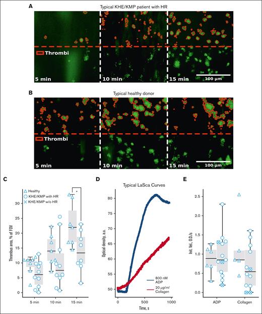 Platelet thrombus formation and aggregation in KHE/KMP. Analysis of platelets from blood samples from healthy children (triangles) and patients with KHE/KMP with (circles) or without (crosses) HR. (A-B) Typical microscopy images of the growing thrombi of patients with KHE/KMP with HR (A) and healthy donors (B) after 5, 10, and 15 minutes of the whole hirudin-anticoagulated blood perfusion through fibrillar collagen-coated flow chamber. Thrombi (highlighted in red) were identified by DiOC-6 fluorescence (green). (C) Scaled thrombi areas at different time points. (D) Typical aggregation curves for the LaSca assays after activation with 800 nM ADP (black curves) or 20 μg/mL collagen (red curve). (E) Initial velocities of platelet aggregation induced by 800 nM ADP or 20 μg/mL collagen. Statistical significance was calculated using Mann-Whitney U test; ∗ P < .05.