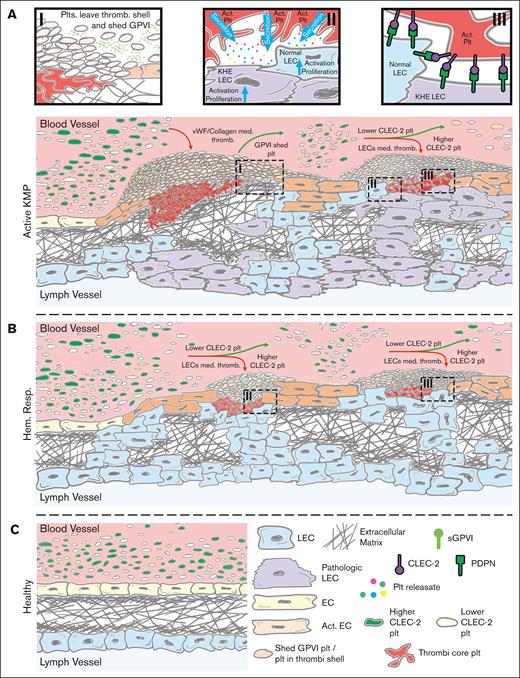 Proposed scheme of the KHE/KMP impact on patient platelets. (A) KHE pathogenesis is mostly based on aberrant VEGFR signaling in LECs.9 These LECs are constitutively proliferating and subsequently intervene in the blood vessel endothelium, thus causing blood endothelium activation, disruption, and extracellular matrix exposure to the blood flow (Ai).9,10 Exposed collagen causes the initiation of platelet thrombus formation and subsequent thrombocytopenia due to platelet consumption. Thrombi are heterogenous in nature; although platelets in the thrombus core are highly activated by a combination of collagen, thrombin, and platelet granule contents, platelets in the thrombus shell are stimulated mostly by ADP and thromboxane.50 Here, platelets in the outer layers of the thrombus can leave the thrombus shell and return to the circulation.50,56 Meanwhile, even moderate platelet activation can cause platelet GPVI receptor shedding.57 Thus, these preactivated platelets (orange platelets on the scheme) become less responsive to further GPVI-mediated activation (Ai). In the meantime, pathologically proliferating LECs also intrude the blood flow and, via the podoplanin-CLEC-2 axis, initiate platelet adhesion and activation (Aii-iii).9,10 Active platelets secrete growth factors stored in their granules, which causes additional LEC and EC activation and proliferation, thus acting as a positive feedback loop (Aii).9,58 Finally, platelets are heterogenous because of the mechanisms of their production: platelets are “ripped” from the megakaryocytes, and thus, platelet membrane receptor expression is not uniform.54 Hereby, it can be expected that some of the platelets in the blood flow have higher CLEC-2 levels (green platelets on the scheme) and some have lesser CLEC-2 levels (white platelets on the scheme). LECs, by exposing podoplanin to the blood flow, capture platelets with higher CLEC-2 levels, acting like filters. Hence, only platelets with lesser CLEC-2 on the surface, those cannot be effectively captured by the LECs, remain in circulation (Aiii). (B) Upon HR, proliferation of the LECs is abrogated because chemotherapy inhibits their VEGF signaling. This allows the blood vessel endothelial cells to cover the exposed extracellular matrix and thus significantly reduce pathological thrombus formation. However, despite being inhibited, LECs still remain in the blood vasculature and still filter platelets with higher CLEC-2 levels (Biii). These platelets secrete growth factors from their granules and thus activate remaining LECs, which maintain LECs’ presence in the blood flow (Bii). (C) Finally, upon recovery, no LECs are exposed to blood flow.