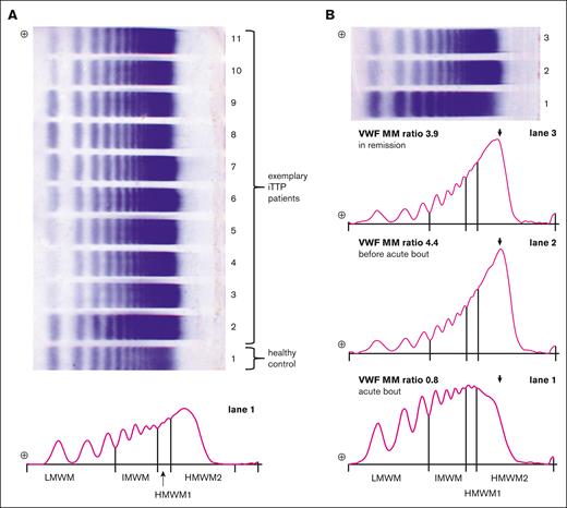 VWF MM ratio evaluation. (A) Exemplary VWF MM gel with plasma samples from patients with iTTP (lanes 2-11) and from a healthy control (lane 1). The densitometry trace below the stained gel represents lane 1 with its electrophoretic pattern divided in 4 zones according to the molecular weight: LMWM; IMWM; HMWM1; and HMWM2. The VWF MM ratio is defined as HMWM2/ LMWM. (B) Electrophoretic patterns and densitometry traces of 1 patient with iTTP in the course of the disease. Lane 3: in remission; lane 2: before acute bout; lane 1: in the acute bout before first TPE.