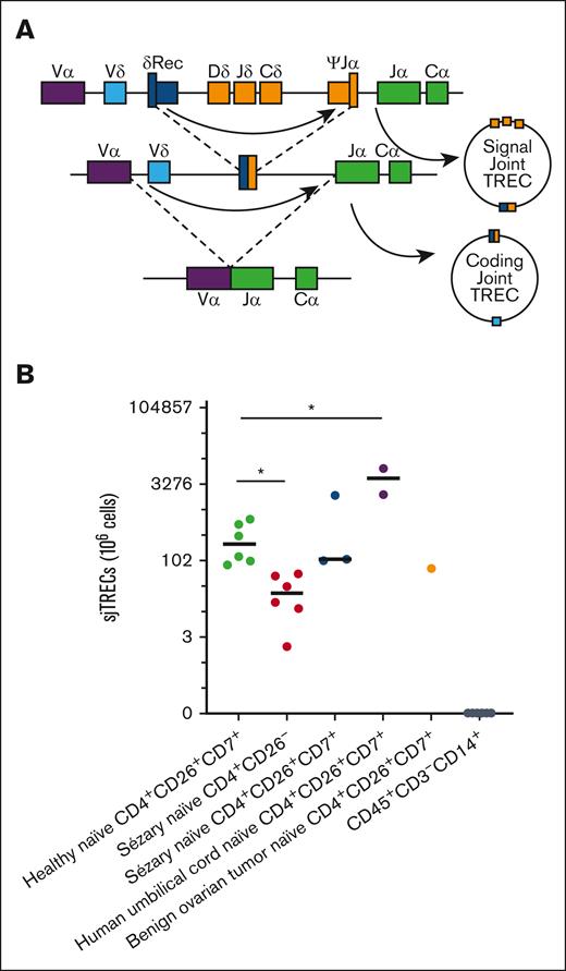 Thymic egression of SS. (A) Schematic of recombination events in TCR rearrangement to generate signal joint TRECs and coding joint TRECs. (B) Quantification of sjTREC via real-time qPCR from naïve T cells from peripheral blood of CTCL patients that are CD4+CD26− (n = 6) or CD4+CD26+ (n = 3) compared to age-matched healthy donors (n = 6), cord blood, benign ovarian tumor peripheral patient blood, and sample matched CD14+CD3− monocytes (n = 6) using total DNA. Data are presented as mean ± standard error of the mean (SEM). ∗P < .05. Unpaired 2-tailed t test was used for calculating differences between means between experimental groups.